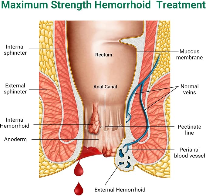 Hemorrhoid Treatment Ointment, Maximum Strength Treatment & Fast Relief for Pain, Itching, Burning, Swelling, Fissure, Bleeding, Discomfort, Long-Lasting Internal & External Hemorrhoid Cream(4-Pack)