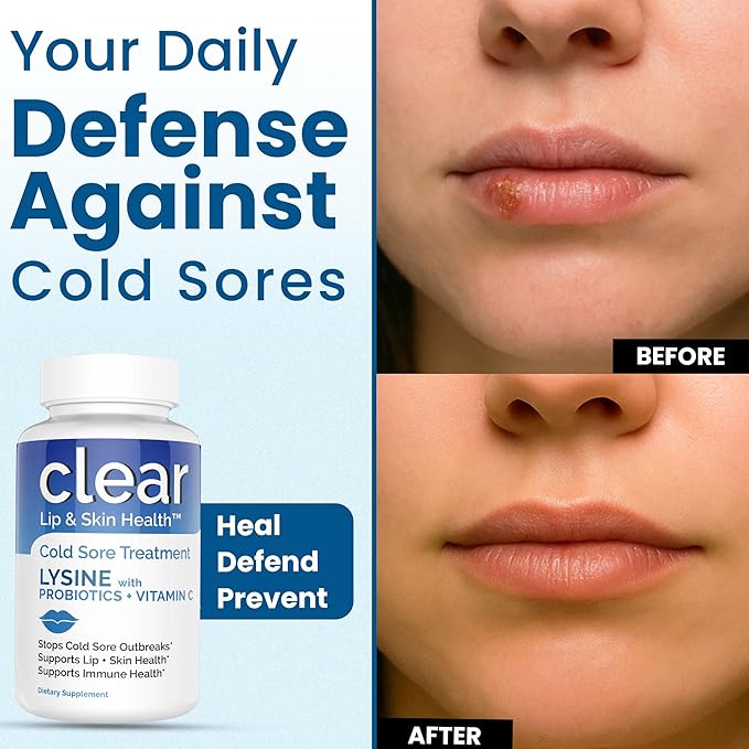 Lysine Cold Sore Treatment for Lips with Pre-Probiotics & VIT C | 1 Month Supply | Supercharged Lysine Capsules with Rhamnosus & Acidophilus for Cold Sores Relief, Skin + Gut Health & Immune Support